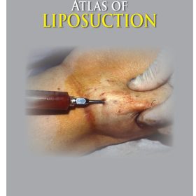 Atlas of Liposuction – Adrien E Aiache, MD; Melvin A Shiffman, MD, JD
