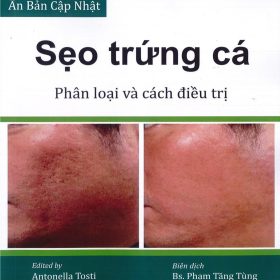 Sẹo trứng cá: Phân loại và cách điều trị: Tài liệu toàn diện về các phương pháp điều trị – Antonella Tosti