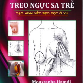 Phẫu thuật Treo Ngực Sa Trễ: Kỹ thuật tạo hình sẹo dọc – Moustapha Hamdi
