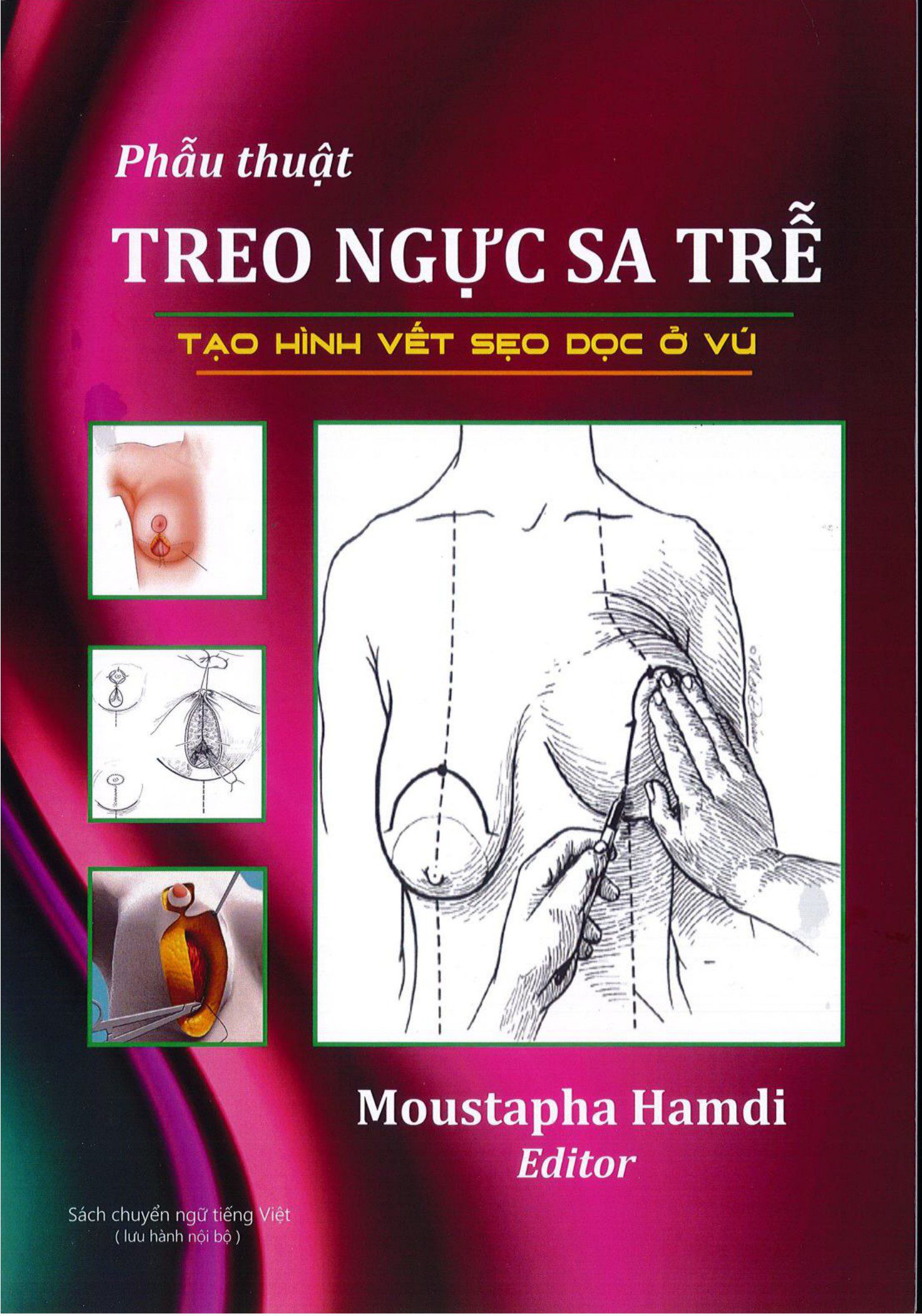 Phẫu thuật treo ngực sa trễ tái tạo vết sẹo dọc Moustapha Hamdi
