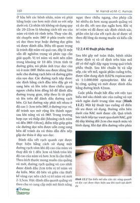 Phẫu thuật Treo ngực sa trễ - Mastopexy vertical scar