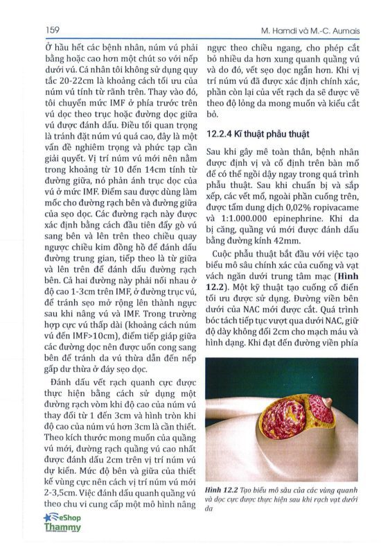 Phẫu thuật Treo ngực sa trễ - Mastopexy vertical scar