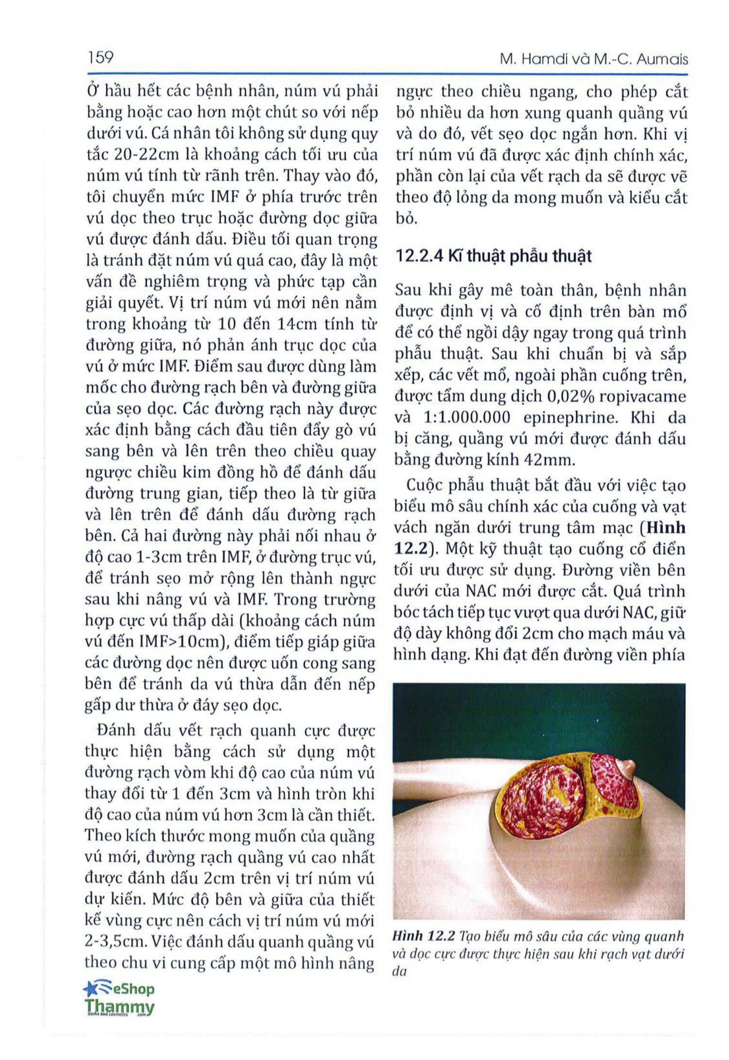 Phẫu thuật Treo ngực sa trễ - Mastopexy vertical scar