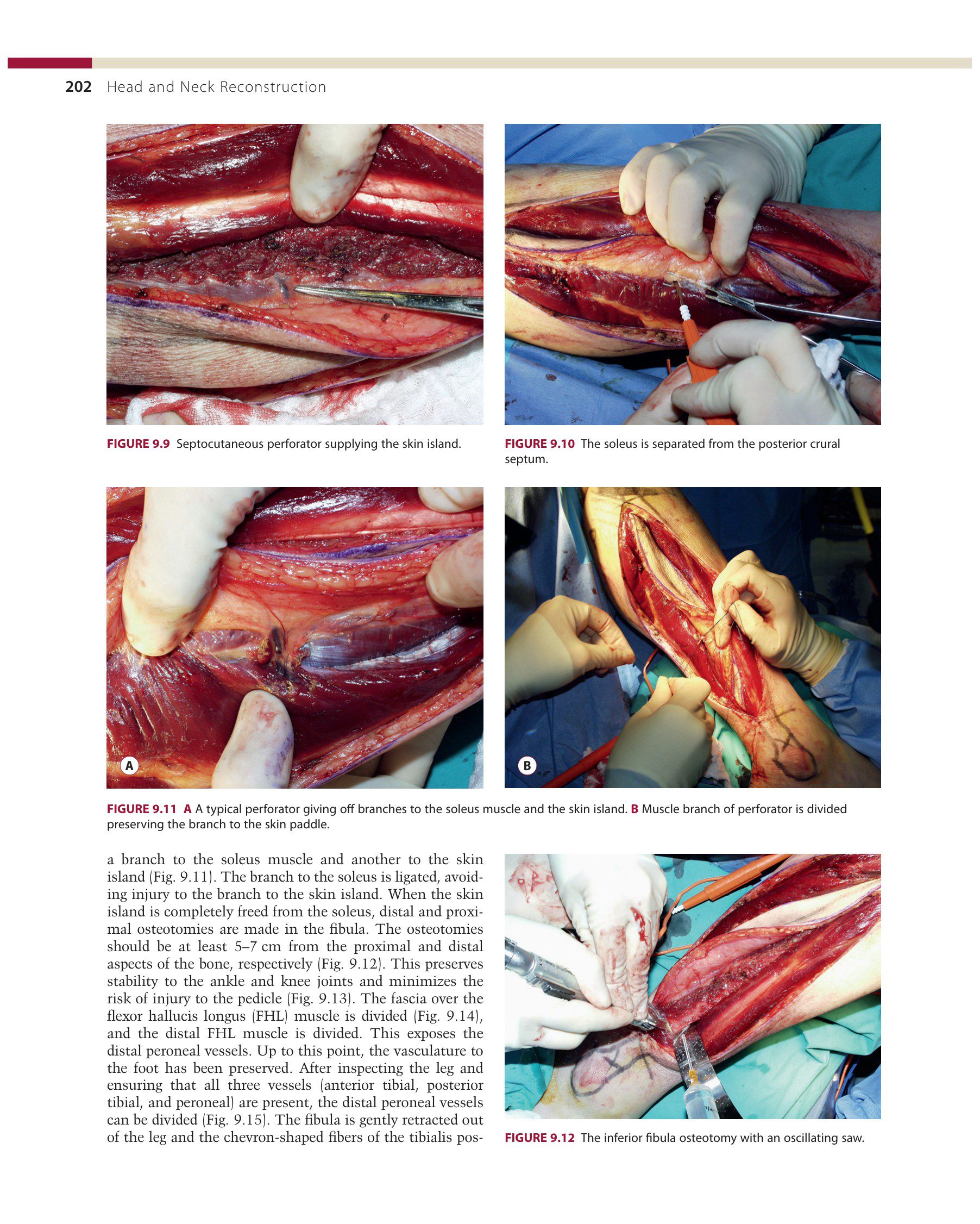 Sách Head and Neck Reconstruction phẫu thuật tạo hình đầu mặt cổ
