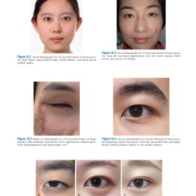 Master Techniques in Facial Rejuvenation 2 (Part 3): [Kỹ thuật căng da mặt & Mí mắt nâng cao] – [Babak Azizzadeh & Mark R. Murphy]