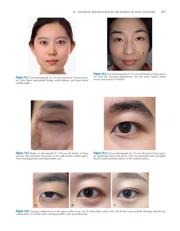 Master Techniques in Facial Rejuvenation 2 part 3 - Kỹ thuật căng da mặt và thẩm mỹ mắt