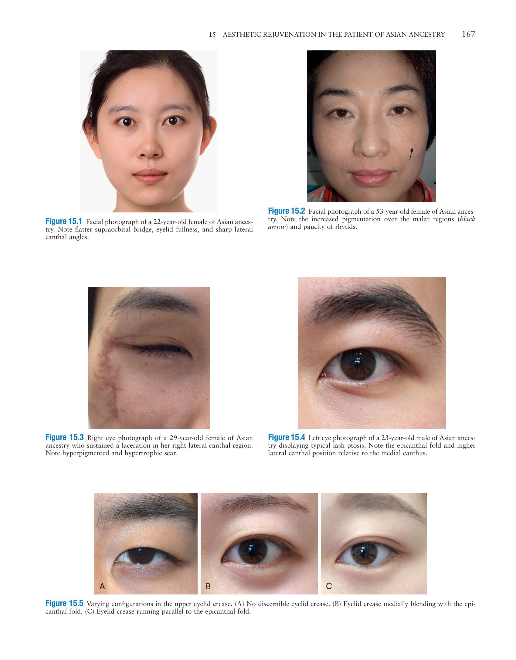 Master Techniques in Facial Rejuvenation 2 part 3 - Kỹ thuật căng da mặt và thẩm mỹ mắt