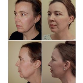 Master Techniques in Facial Rejuvenation (Part 4): Kỹ thuật trẻ hóa khuôn mặt nâng cao – Babak Azizzadeh & Cộng sự
