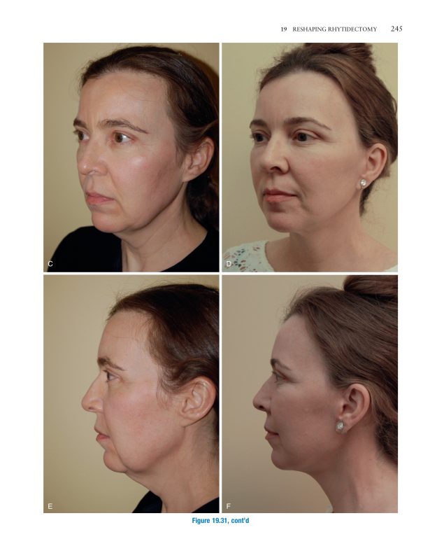 Master Techniques in Facial Rejuvenation 2nd Edition Part 4 cover