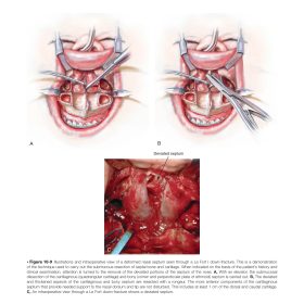 Orthognathic Surgery 2_part2: Nguyên lý và Thực hành Phẫu thuật Chỉnh hình Xương hàm – Jeffrey C. Posnick
