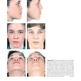 Orthognathic Surgery 2 (Part 5): Phẫu thuật Hàm mặt trong các Hội chứng Sọ mặt & Khe hở môi vòm – Jeffrey C. Posnick