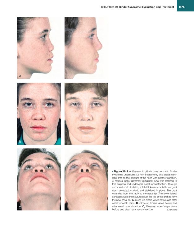 Orthognathic Surgery 2 part 5 - Phẫu thuật tạo hình hàm mặt Jeffrey C. Posnick