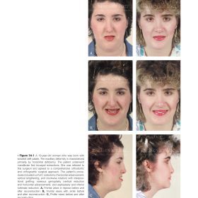Orthognathic Surgery (Phần 6): Điều trị biến dạng hàm khe hở vòm – Jeffrey C. Posnick