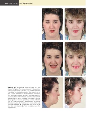 Sách Orthognathic Surgery Principles and Practice Jeffrey C Posnick