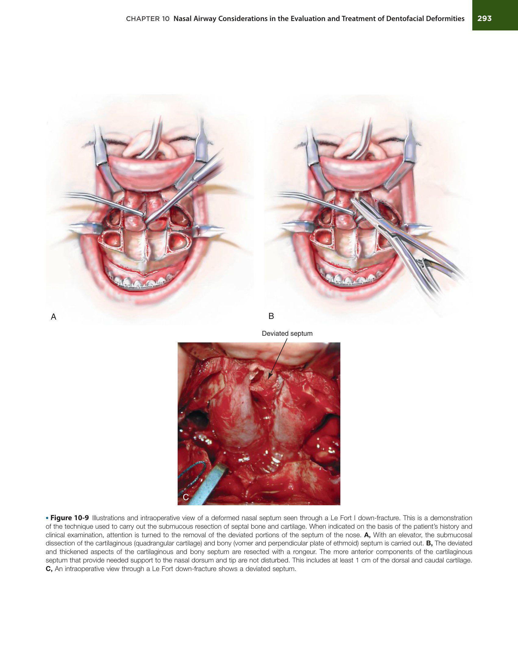 Orthognathic Surgery Part 2