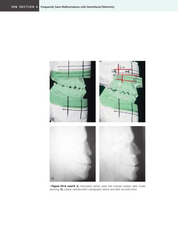 Sách Orthognathic Surgery Principles and Practice