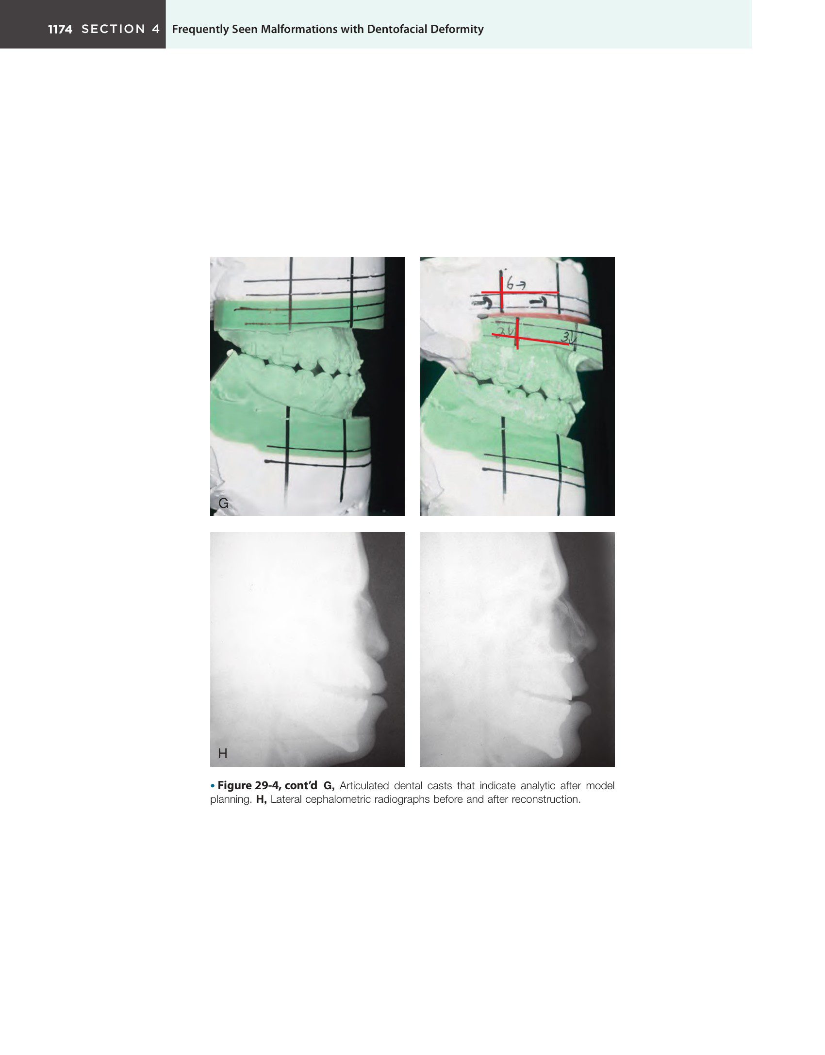 Sách Orthognathic Surgery Principles and Practice