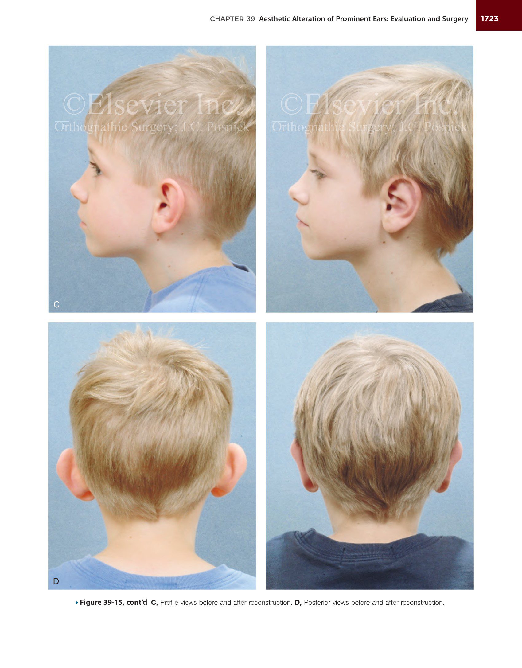 Sách Orthognathic Surgery Principles and Practice Jeffrey C. Posnick - Phần 7