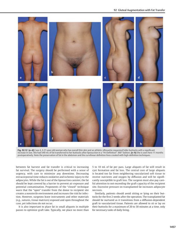 The Art of Aesthetic Surgery Principles and Techniques Volume 3 Part 3 Foad Nahai Body Contouring Genital Rejuvenation