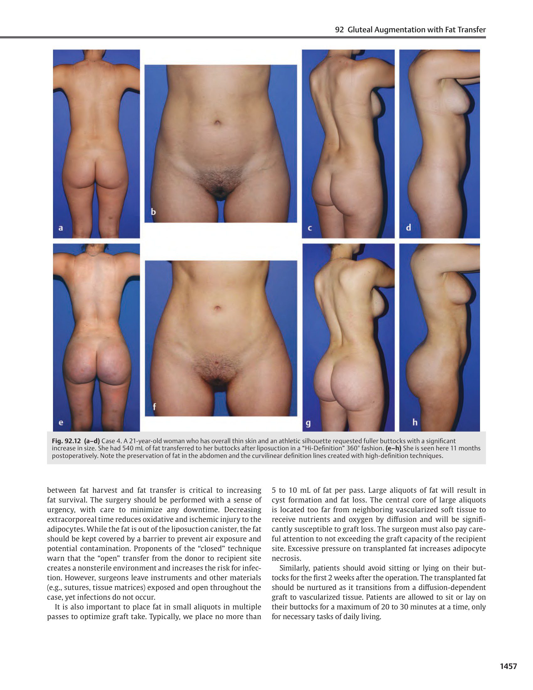 The Art of Aesthetic Surgery Principles and Techniques Volume 3 Part 3 Foad Nahai Body Contouring Genital Rejuvenation