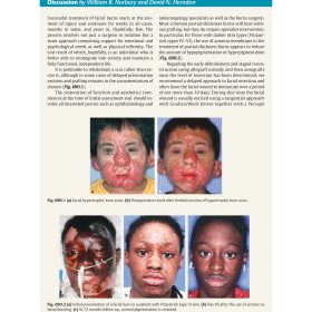 Bỏng Vùng Mặt: Xử Lý Biến Chứng và Tái Tạo – William B. Norbury & David N. Herndon