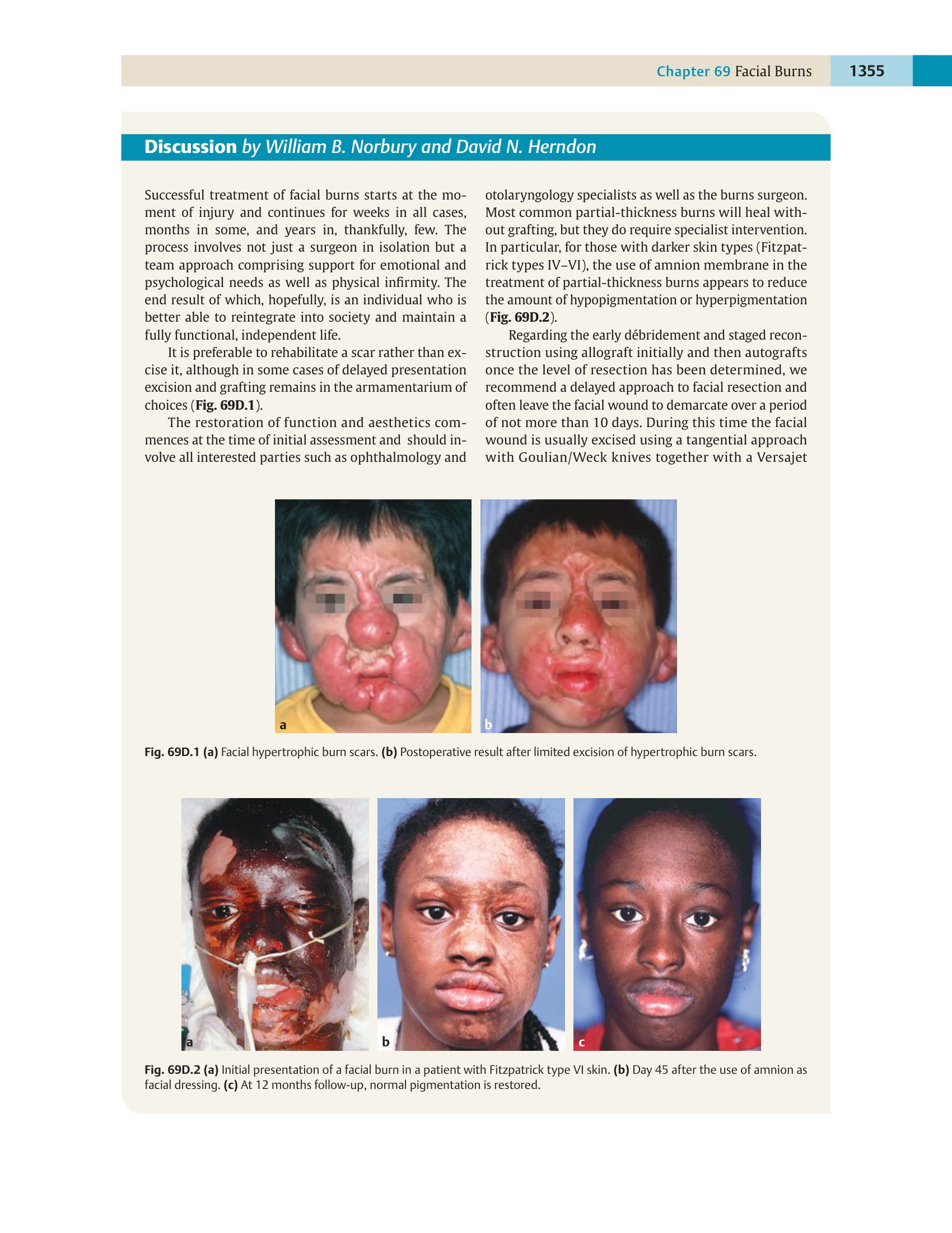 Bìa tài liệu Bỏng Vùng Mặt - Trích từ The Unfavorable Result in Plastic Surgery