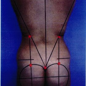 Tạo hình bờ mông hiện đại bằng kỹ thuật Lipofiller hệ thống hóa