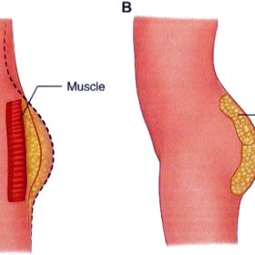 Nâng mông bằng mỡ tự thân: Kỹ thuật tạo đường cong S-Curve