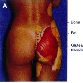 Hệ thống phân loại Mendieta: Đánh giá và lập kế hoạch tạo hình mông